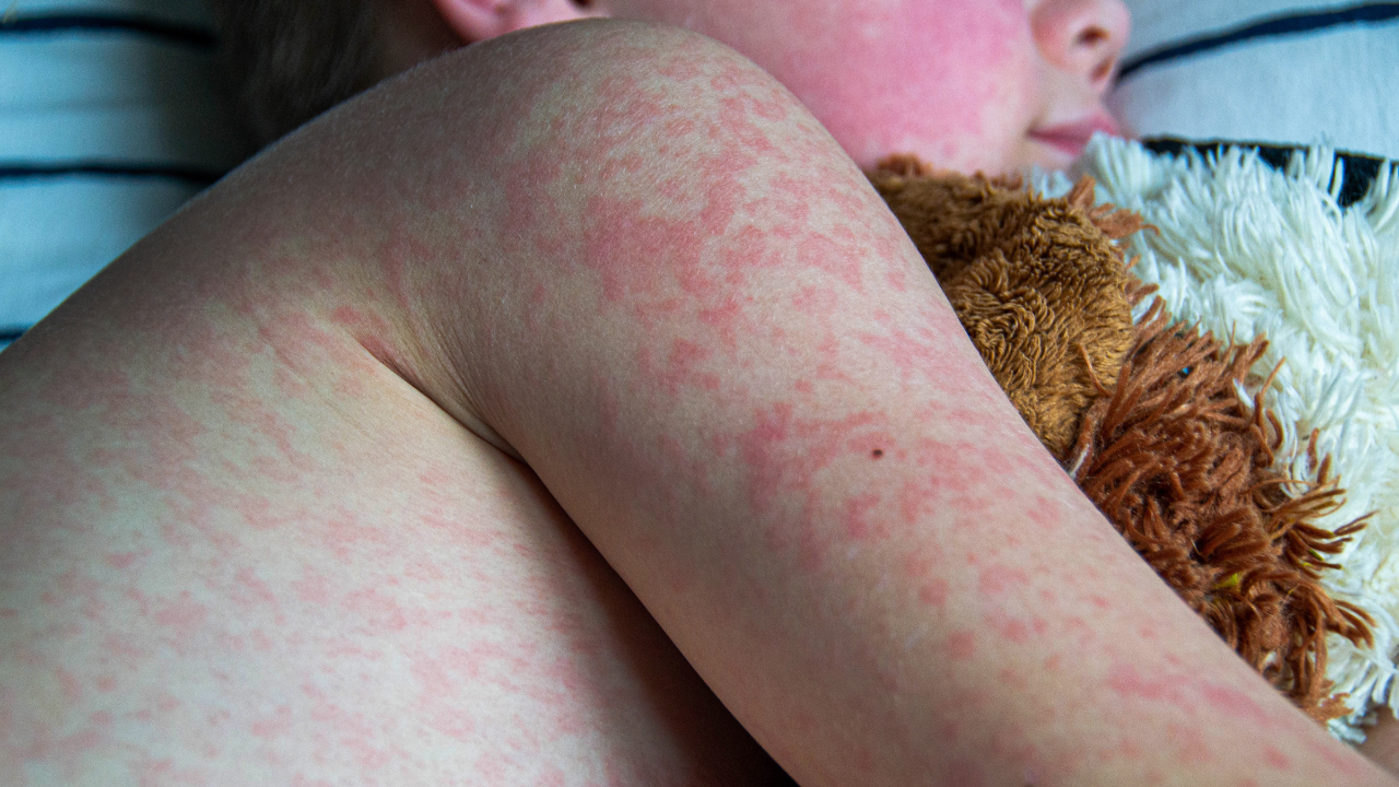 Hospitals fighting measles confront a challenge: Few doctors have seen it before
